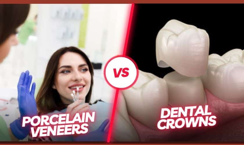 Porcelain Veneers vs Crowns What's the Difference?